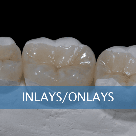 Inlays and Onlays at Friendly Dental of Worcester, Massachusetts ...