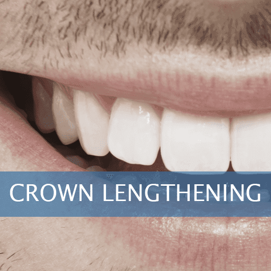 Crown Lengthening Friendly Dental of Worcester