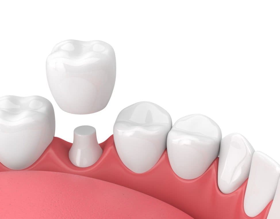 dental_crown - Friendly Dental of Worcester - Friendly Dental of Worcester