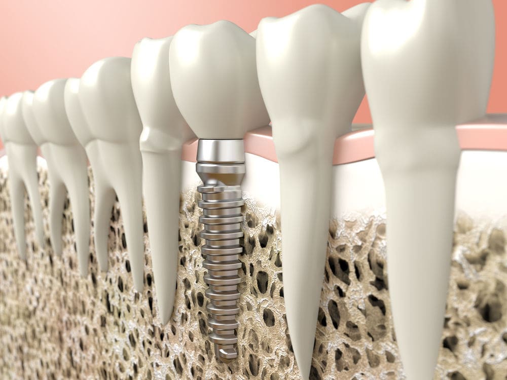 dental implant worcester