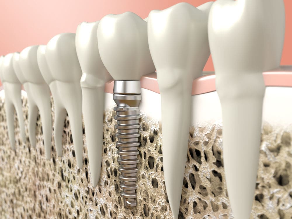 dental implant worcester - Friendly Dental of Worcester - Friendly Dental of Worcester dental implant worcester