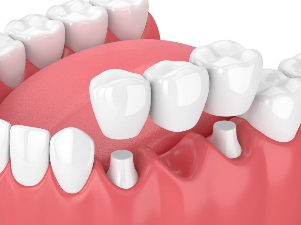dental bridge worcester - Friendly Dental of Worcester - Friendly Dental of Worcester dental bridge worcester
