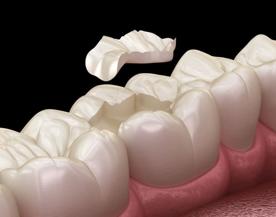 dental restoration worcester - Friendly Dental of Worcester - Friendly Dental of Worcester dental restoration worcester