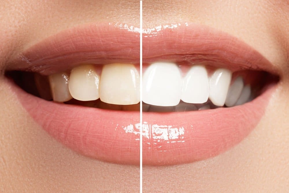teeth_whitening - Friendly Dental of Worcester - Friendly Dental of Worcester
