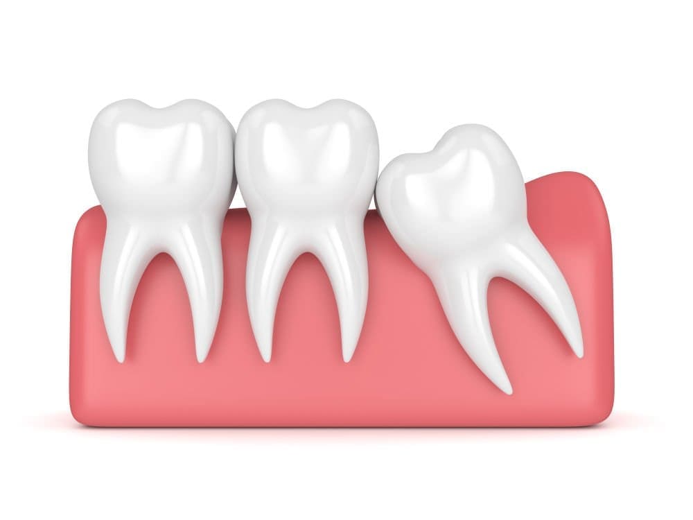 tooth_extraction - Friendly Dental of Worcester - Friendly Dental of Worcester